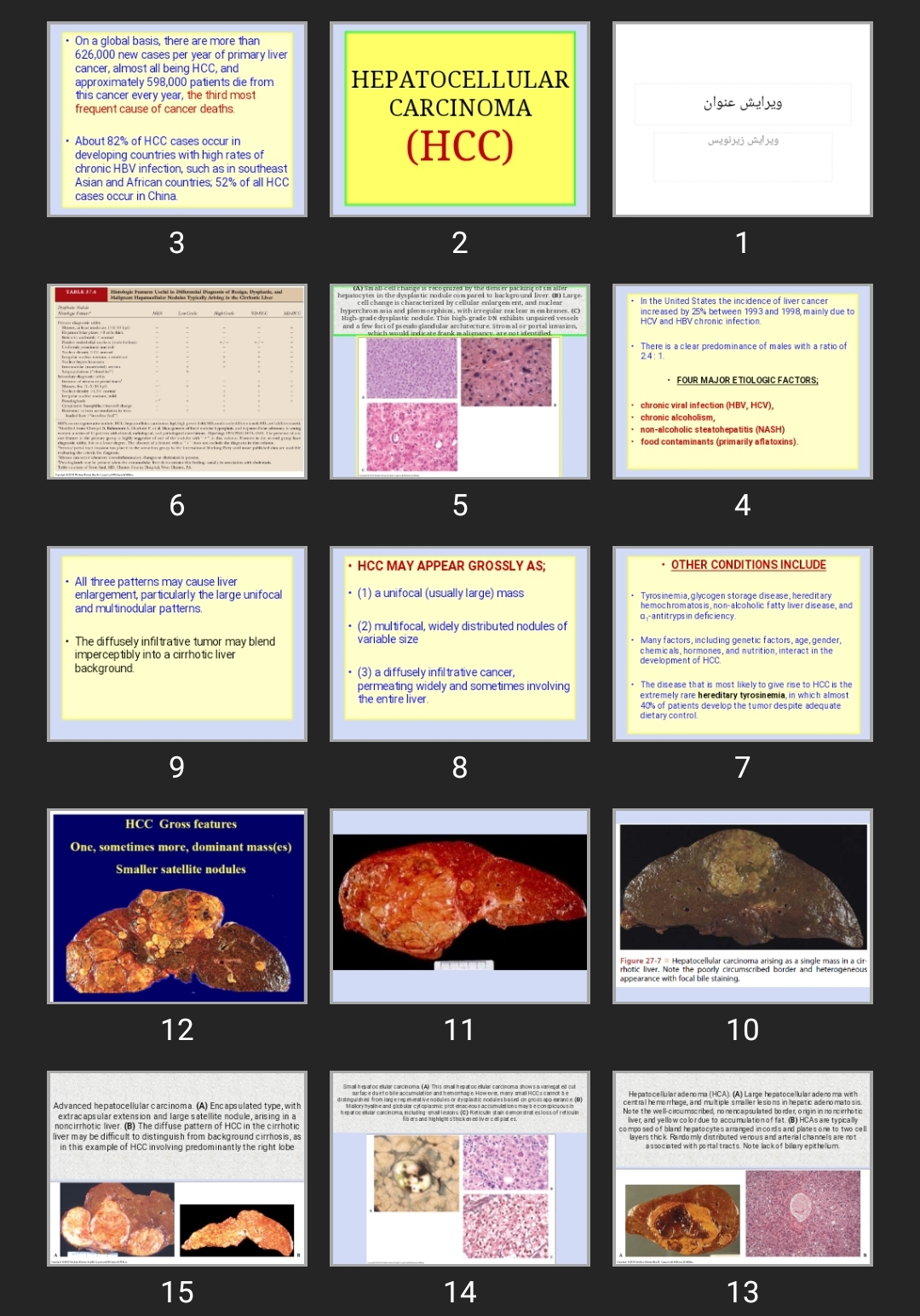 پاورپوینت HEPATOCELLULAR CARCINOMA (HCC)