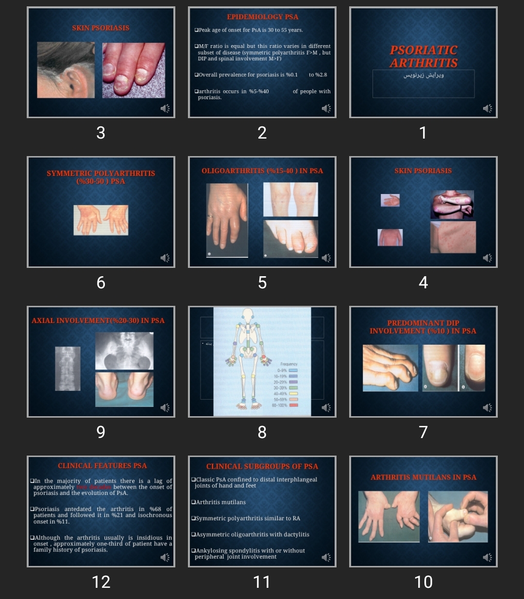پاورپوینت Psoriatic Arthritis