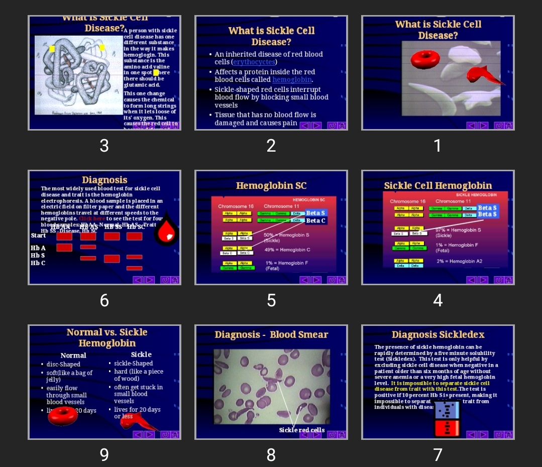 پاورپوینت What is Sickle Cell Disease