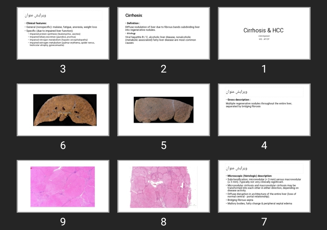 پاورپوینت Cirrhosis & HCC