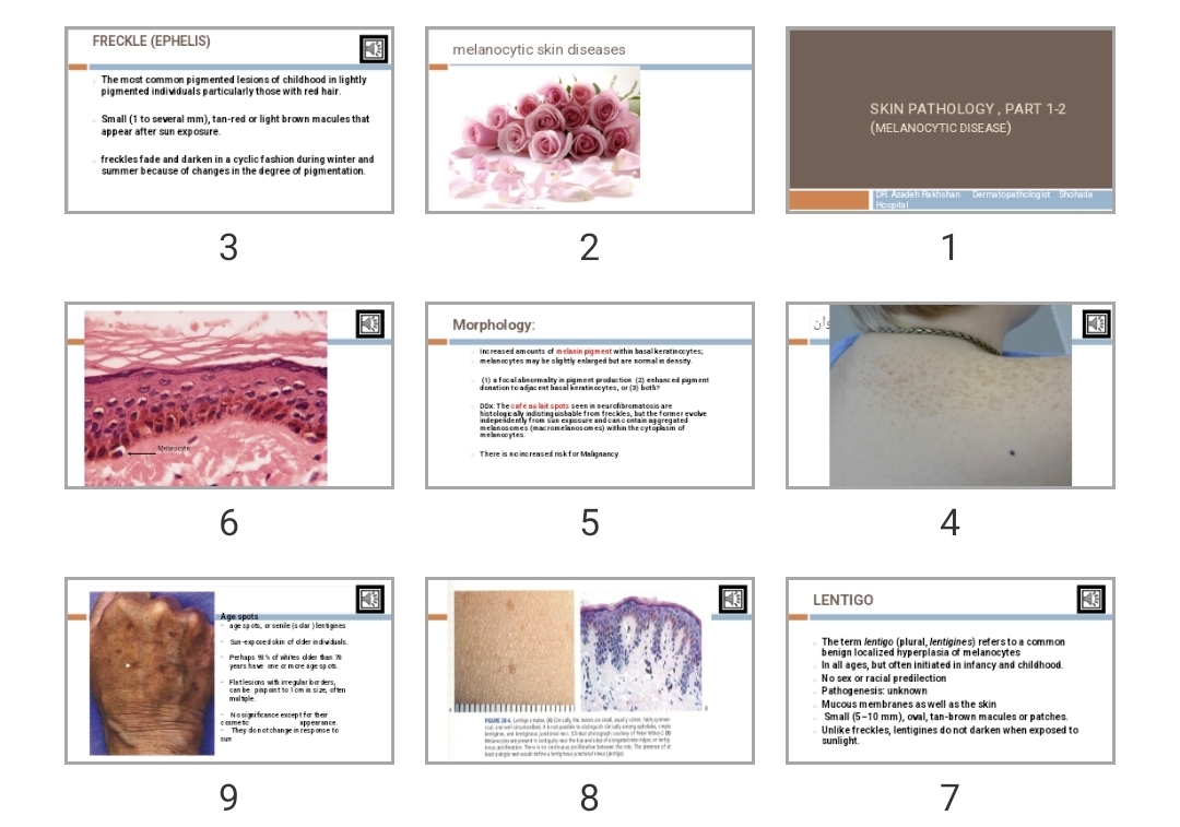 پاورپوینت Skin Pathology , part 1-2 (Melanocytic disease)