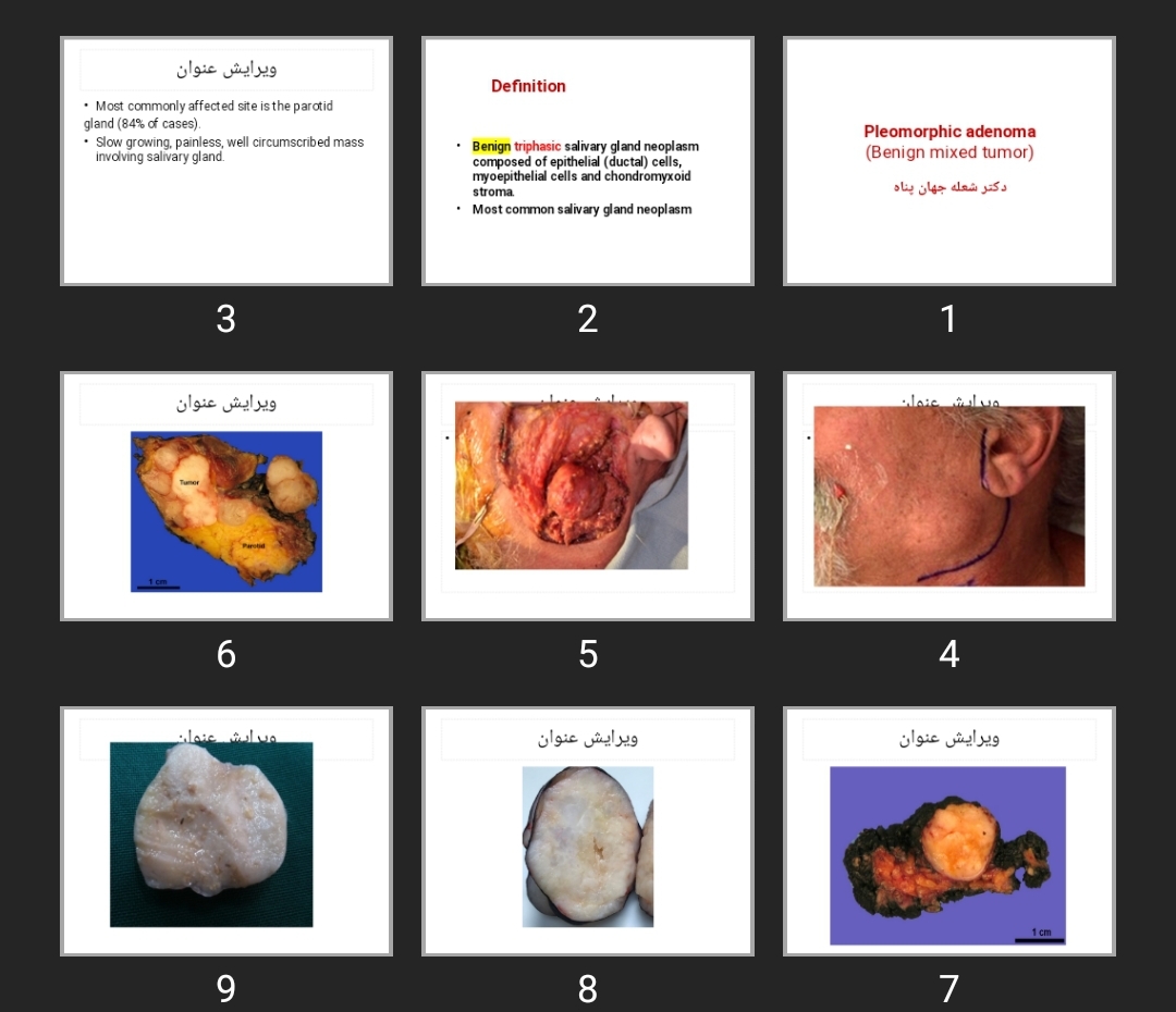 پاورپوینت Pleomorphic adenoma (Benign mixed tumor)