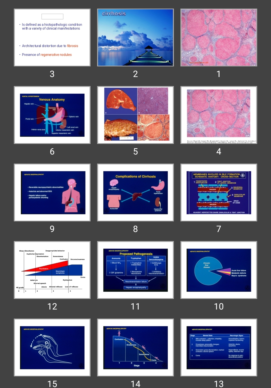 پاورپوینت Cirrhosis