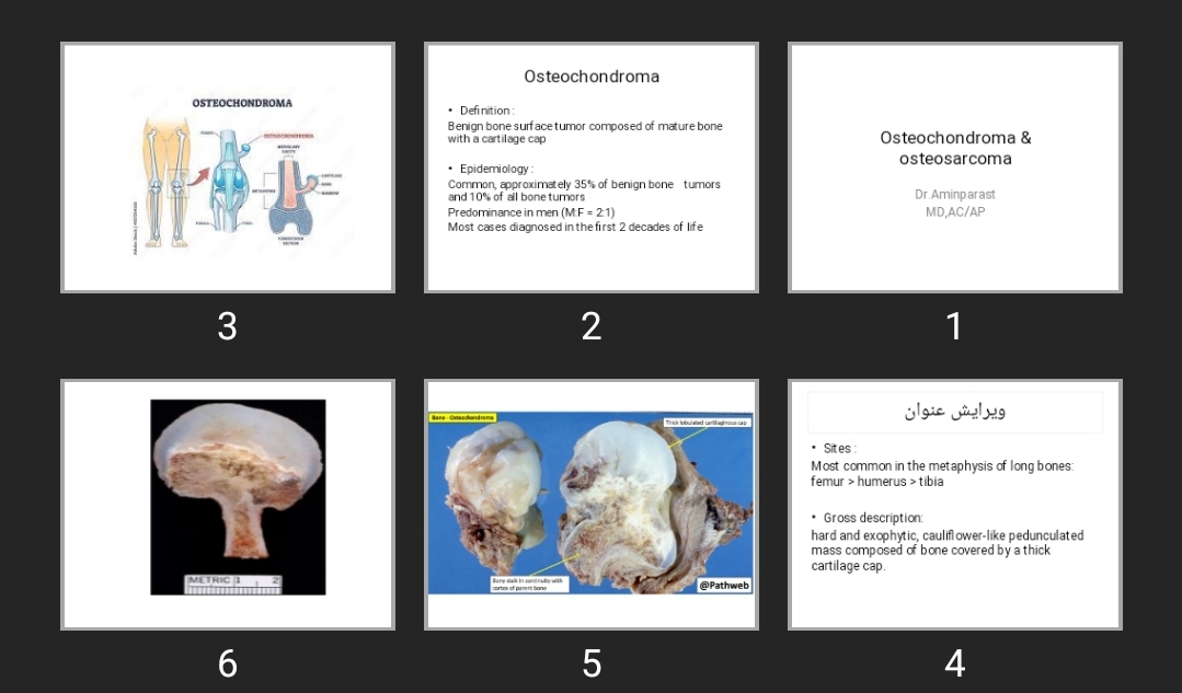 پاورپوینت Osteochondroma & osteosarcoma