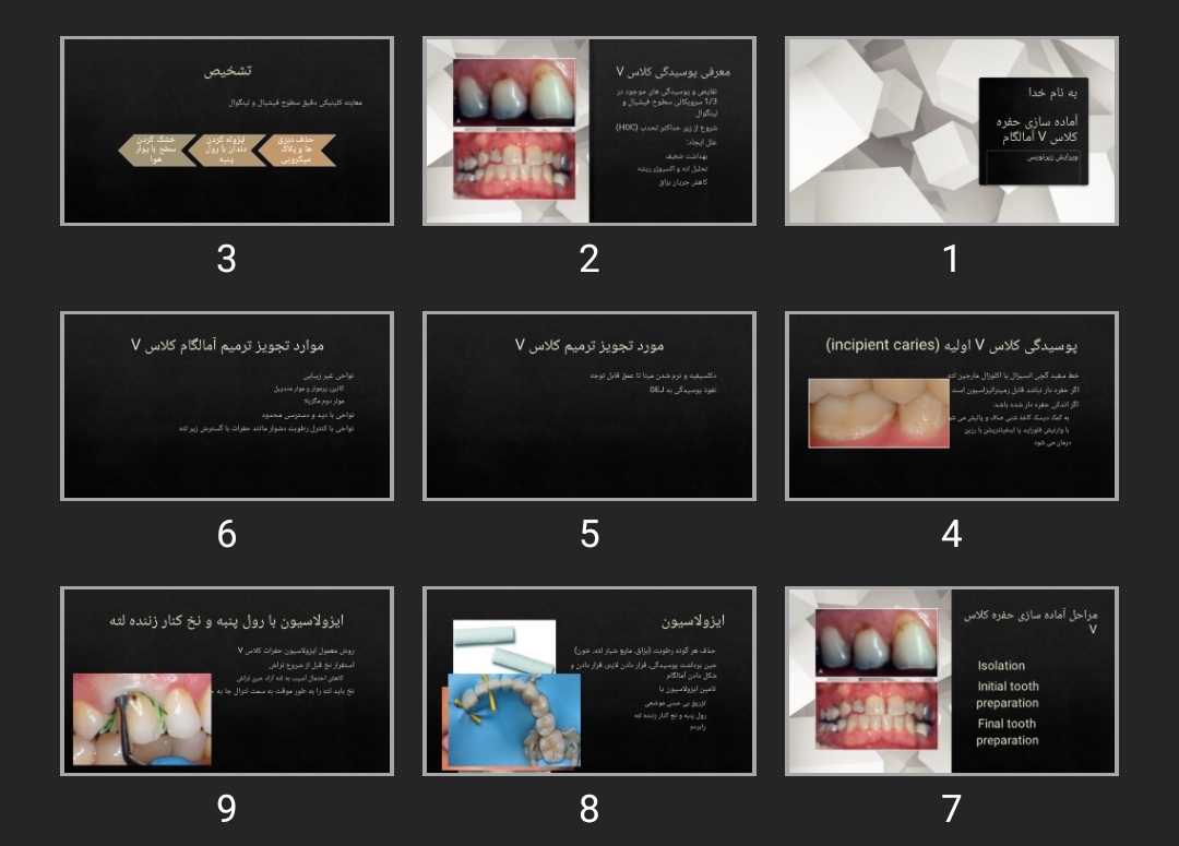 پاورپوینت آماده سازی حفره کلاس V آمالگام