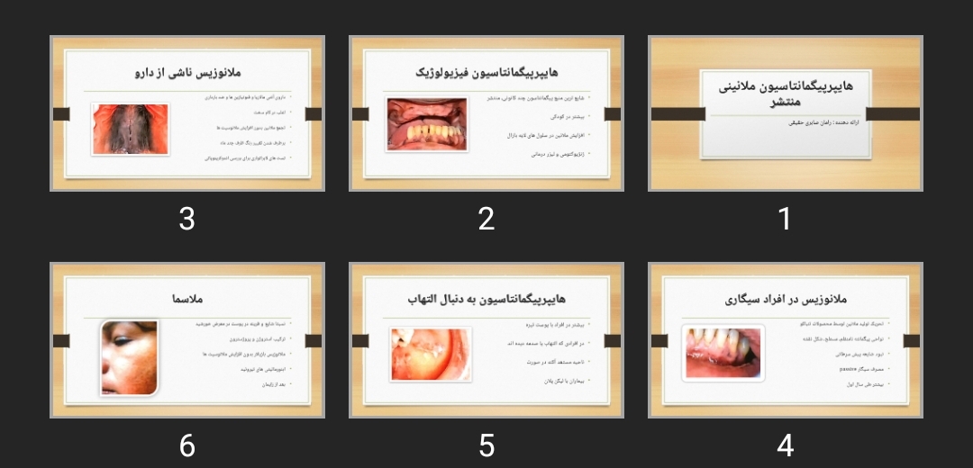 پاورپوینت هایپرپیگمانتاسیون ملانینی منتشر