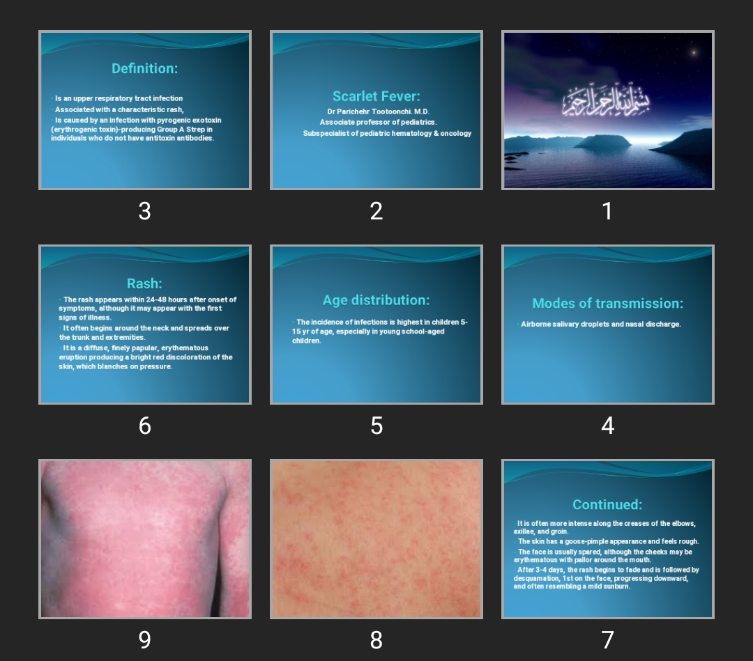 پاورپوینت Scarlet Fever