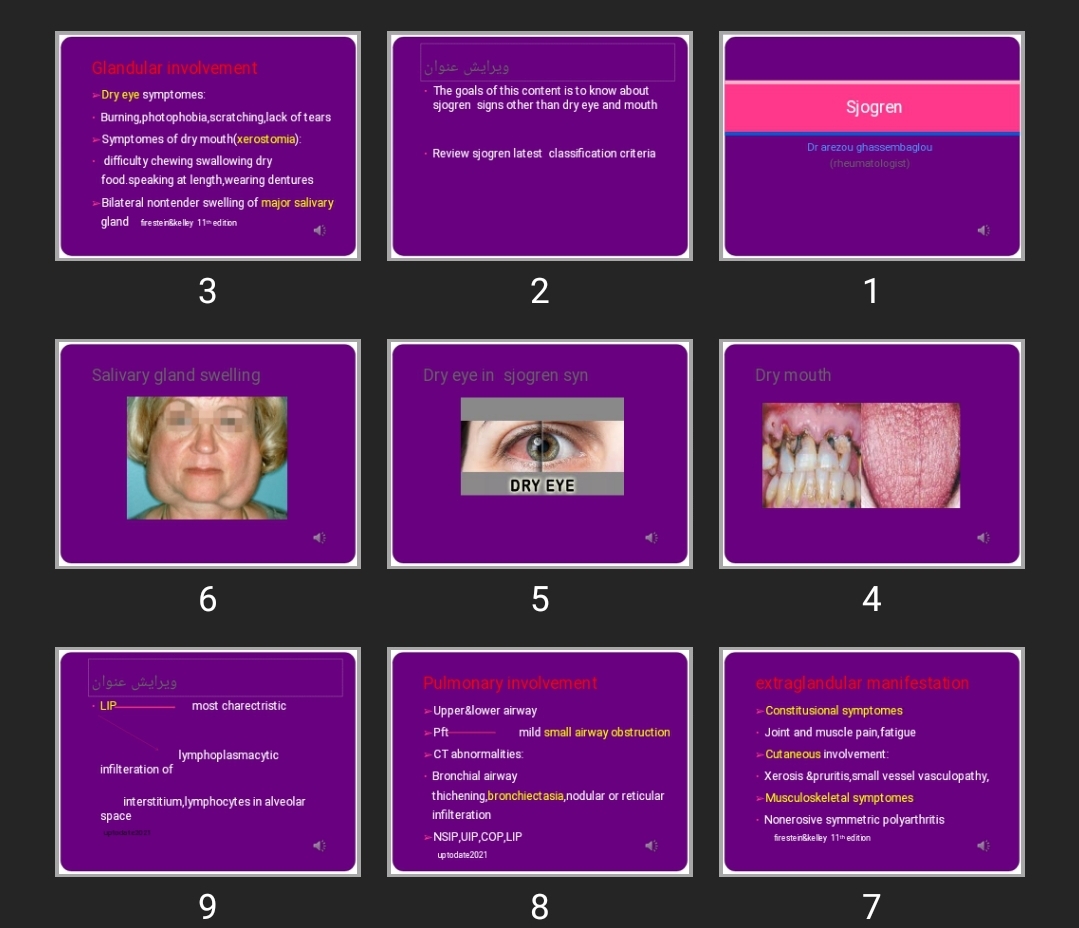 پاورپوینت شوگرن Sjogren