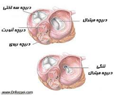 اطلاعات کامل و جامع درباره بیماری‌های دریچه‌های قلبی بیماری‌ها, بیماری دریچه قلبی, دریچه قلب