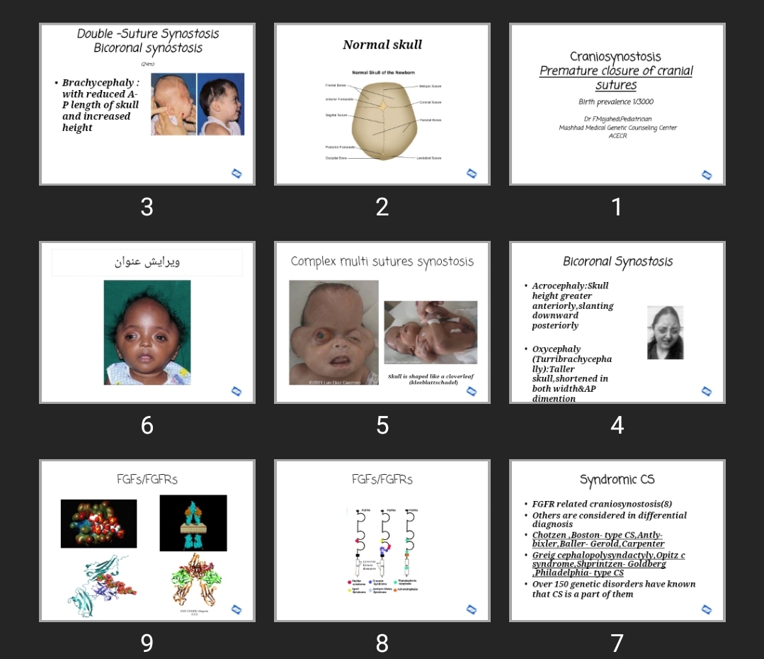 پاورپوینت Craniosynostosis Premature closure of cranial sutures