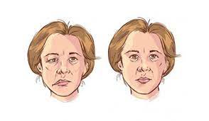   پاورپوینت میاستنی گراویس