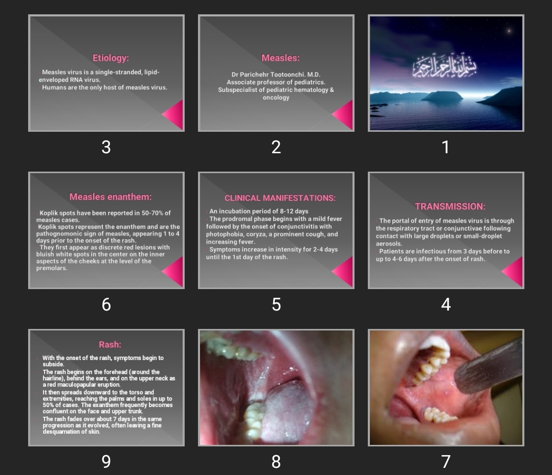 پاورپوینت Measles