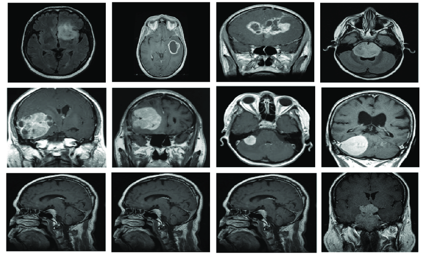 مطالعه و ارزیابی روش های طبقه بندی  تصاویر MRI و CT مغز