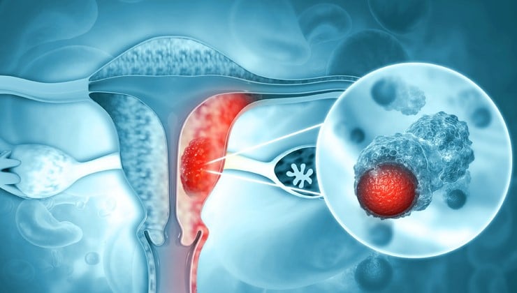 پاورپوینت با موضوع سرطان دهانه رحم