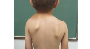 پاورپوینت ناهنجاری شانه نابرابر 38 اسلاید PPTX