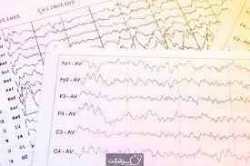 نوار مغزی و بیماری صرع