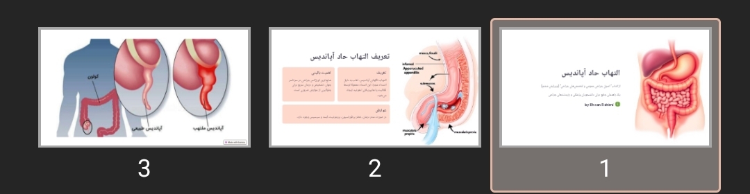 پاورپوینت التهاب حاد آپاندیس