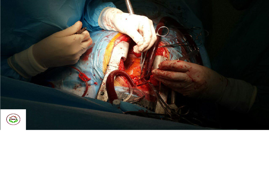 راهنمای عمل جراحی قلب
