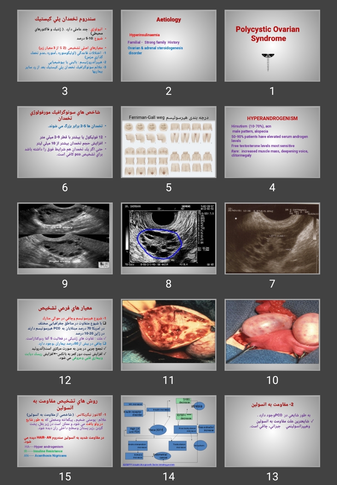 پاورپوینت سندروم تخمدان پلی كيستيک Polycystic Ovarian Syndrome