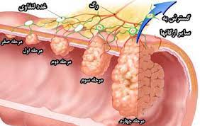   فایل پولیپ های روده بزرگ (کولون)