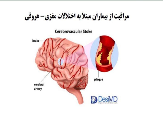 مراقبت از بیماران مبتلا به اختلالات مغزی-عروقی