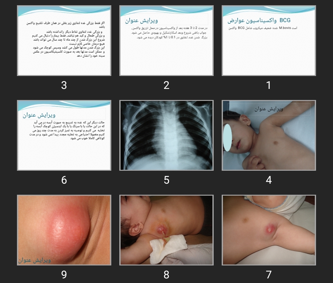 پاورپوینت عوارض واکسیناسیون BCG