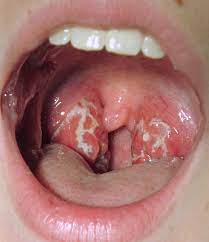   فایل اپرچ به acute pharyngitis در بالغین