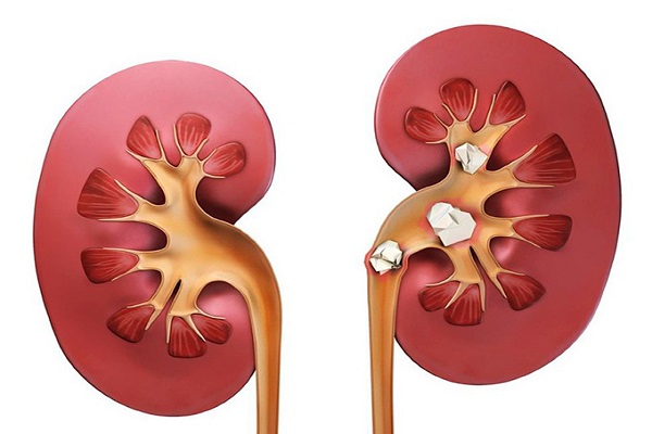 پاورپوينت درمان بيماري هاي کليه