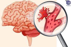   پاورپوینت خونریزی مغزی IntraCranial Haemorrhage
