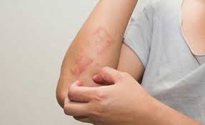   پاورپوینت عفونت های پوستی باکتریال