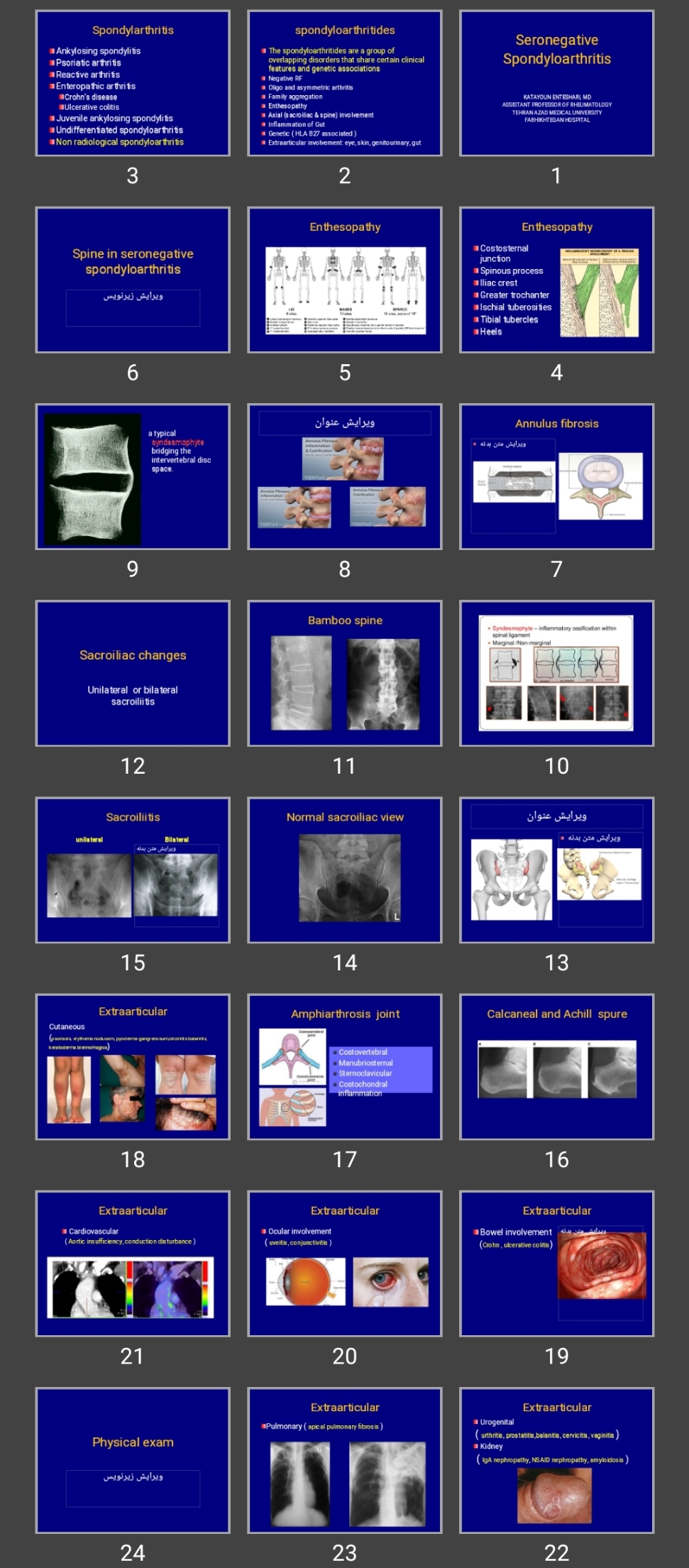 پاورپوینت Seronegative Spondyloarthritis