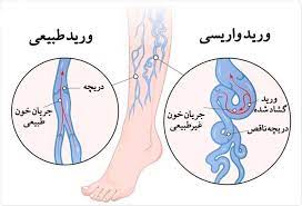   جزوه بیماری های وریدی venous disease  دانشگاه علوم پزشکی تهران