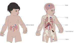 دانلود پاورپوینت نوروبلاستوما اطفال